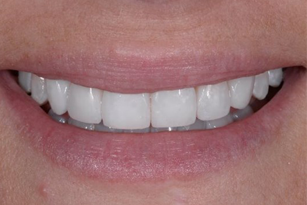 Cosmetic Bonding After Case E Dr. Ferrari