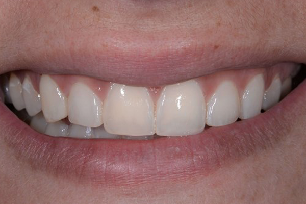 Cosmtic Bonding After Case D Dr. Ferrari