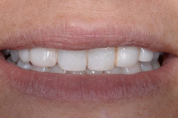 Cosmetic Bonding Before Case E Dr. Ferrari