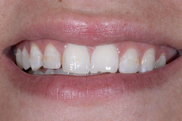 Cosmtic Bonding Before Case D Dr. Ferrari