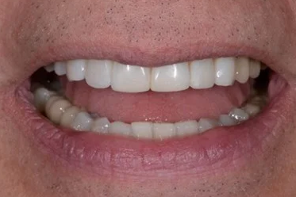 gallery-practitioner-dr-angel-ferrari after cosmetic bonding
