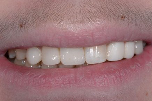 Dr. Angela Ferrari Cosmetic Bonding After Case