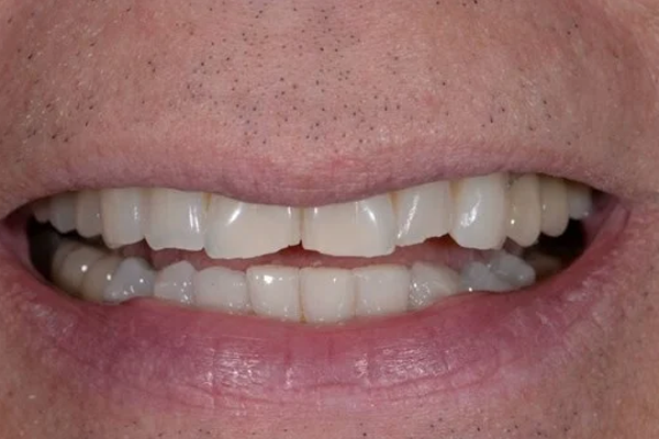 gallery-practitioner-dr-angel-ferrari before cosmetic bonding