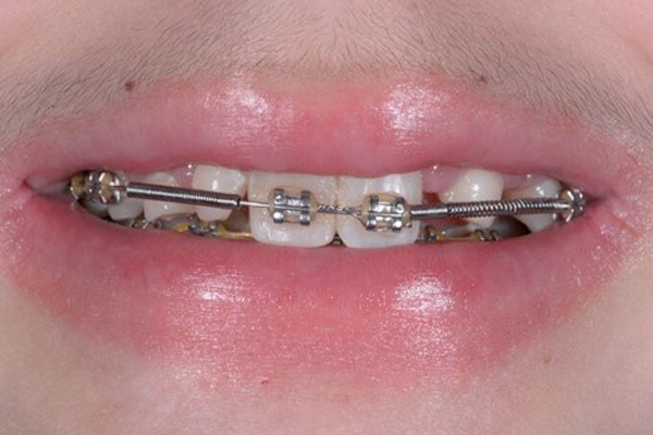 Dr Angela Ferrari Cosmetic Bonding before case