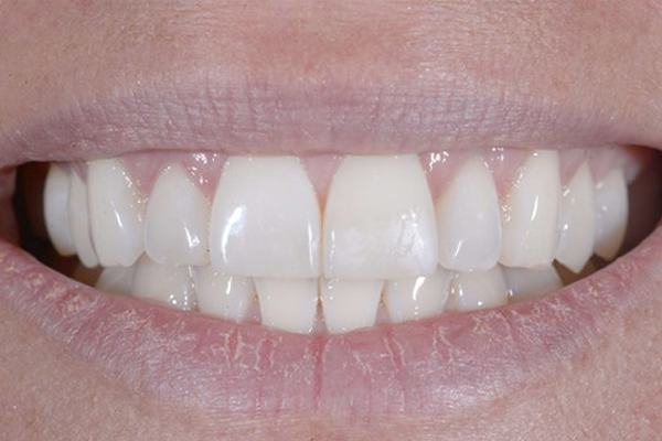 Cosmtic Bonding After Case C Dr Ferrari