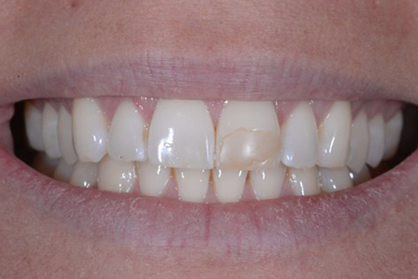 Cosmetic Bonding Before Case C Dr Ferrari<span id=