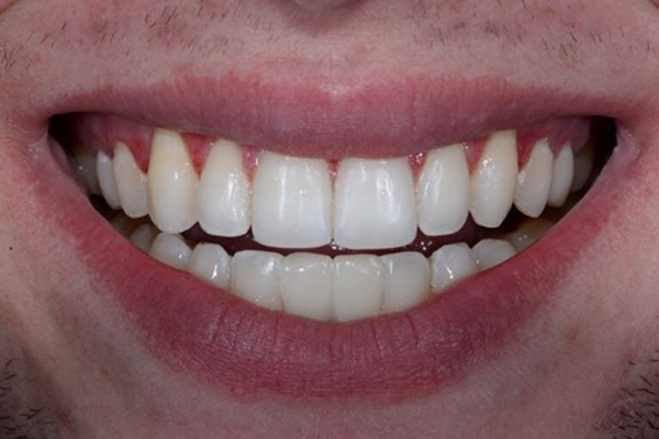 Dental Bridges After Case A Dr. Angela Ferrari