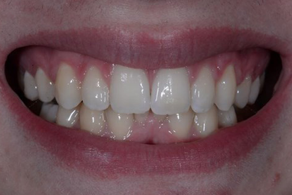 Dental Bridges Before Case A Dr. Angela Ferrari