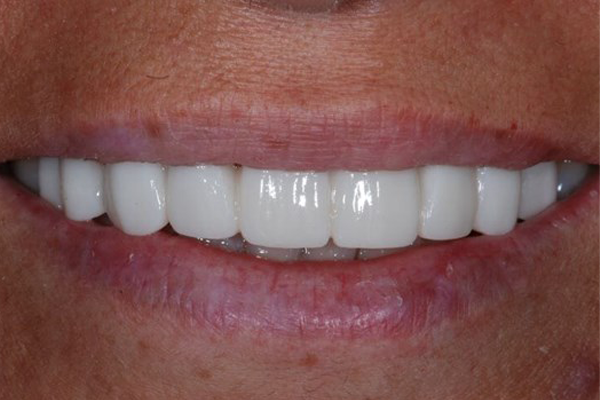 After Case - Dental Bridges Dr. Daniel Aldieri