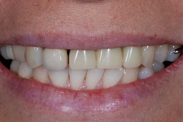 Before Case - Dental Bridges Dr. Daniel Aldieri