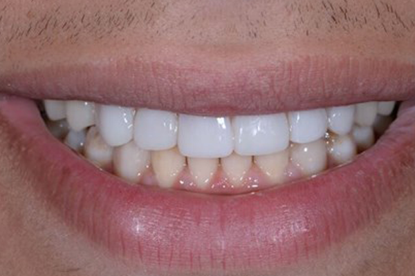 Dental Crown After Case B Dr. Angela Ferrari