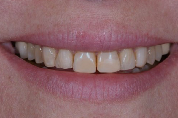 Dental Crowns Before Case A Dr. Angela Ferrari