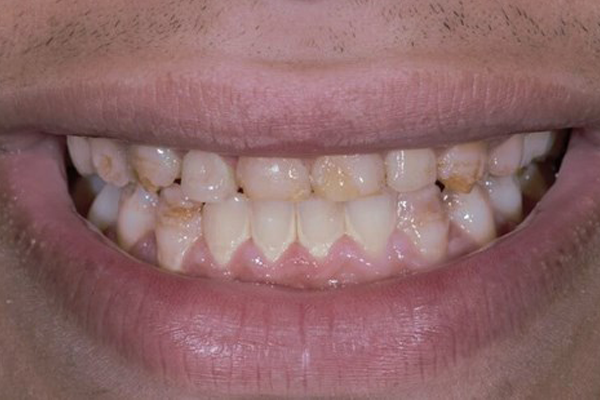 Dental Crowns Before Case B Dr. Angela Ferrari