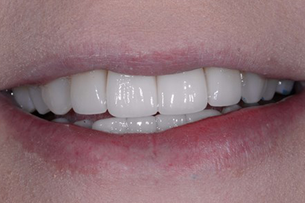 Dental Crowns After Case C Dr. Angela Ferrari