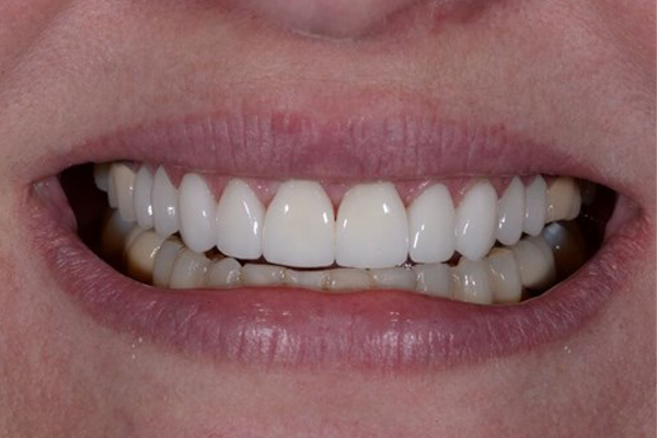 Dental Crowns After Case A Dr. Angela Ferrari