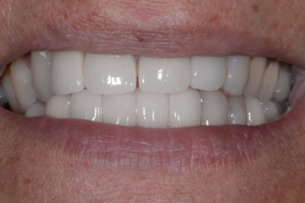 Dental Crowns After Case D Dr. Angela Ferrari