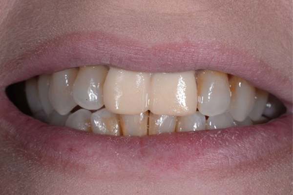 Dental Crowns Before Case C Dr. Angela Ferrari