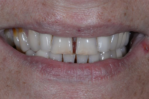 Dental Crowns Before Case D Dr. Angela Ferrari