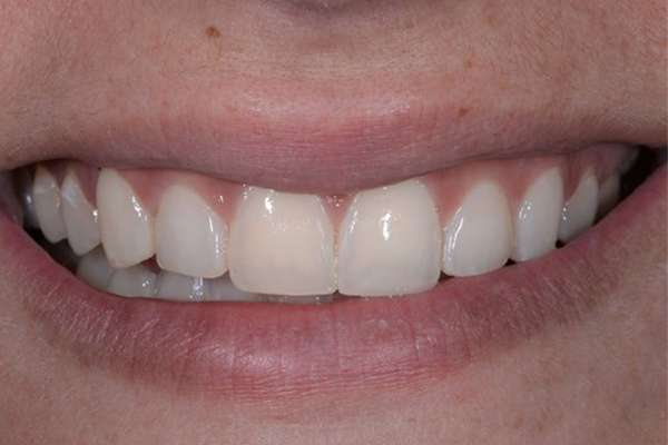 Invisalign After Case D Dr. Angela Ferrari