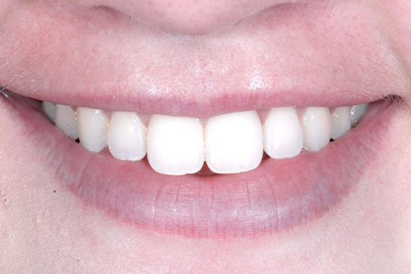 Invisalign After Case E Dr. Angela Ferrari
