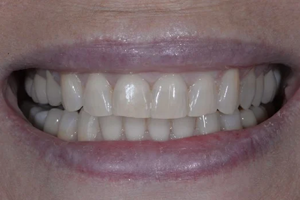 Invisalign After Case F Dr. Angela Ferrari