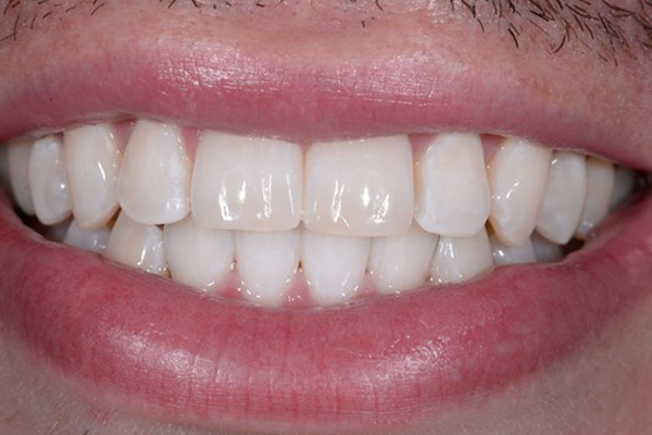 Invisalign After Case G Dr. Angela Ferrari