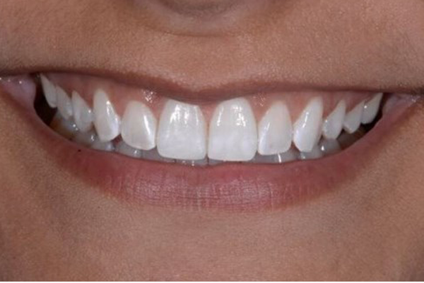 Invisalign After Case H Dr. Angela Ferrari