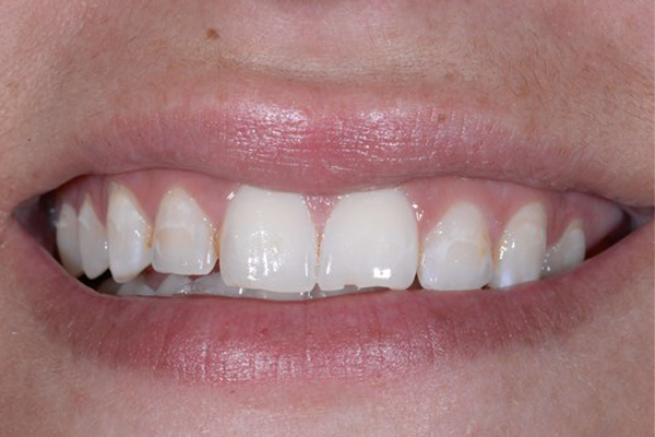 Invisalign Before Case D Dr. Angela Ferrari