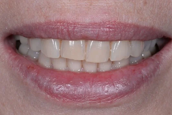 Invisalign Before Case F Dr. Angela Ferrari