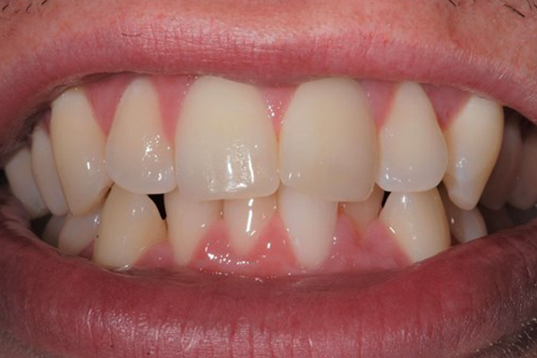 Invisalign Before Case G Dr. Angela Ferrari