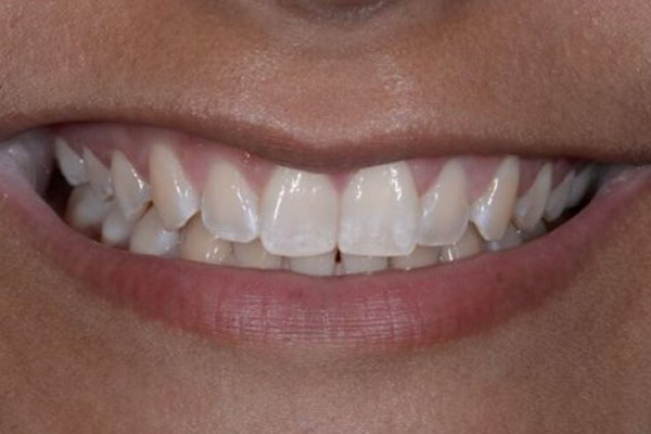 Invisalign Before Case H Dr. Angela Ferrari