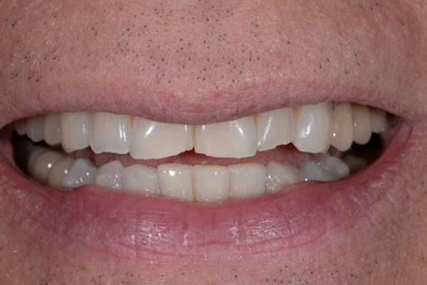Invisalign After Case A Dr. Angela Ferrari