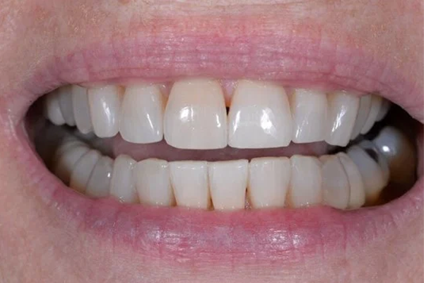 Invisalign After Case C Dr. Angela Ferrari