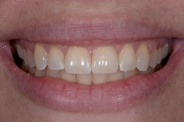 Invisalign After Case C Dr. Angela Ferrari