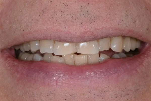 Invisalign Before Case A Dr. Angela Ferrari