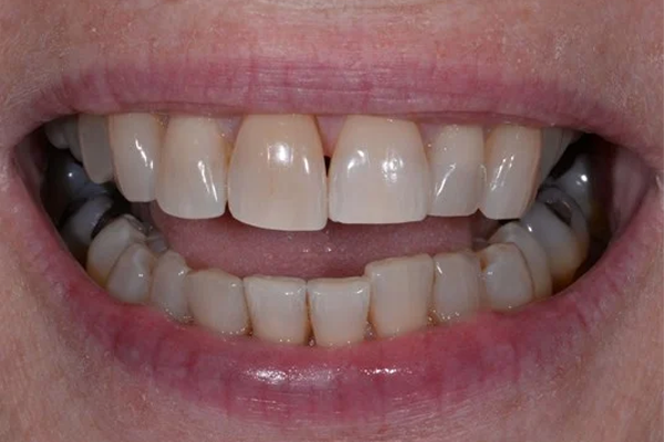 Invisalign Before Case C Dr. Angela Ferrari