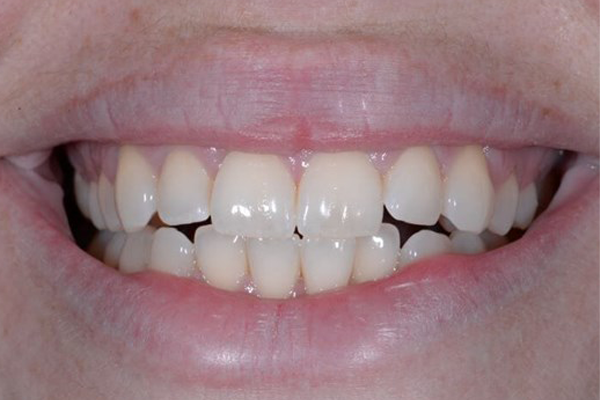 Invisalign Before Case C Dr. Angela Ferrari