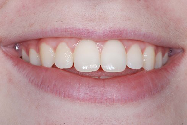 Invisalign Before Case E Dr. Angela Ferrari