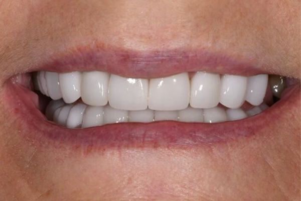 Porcelain Veneers After Case B