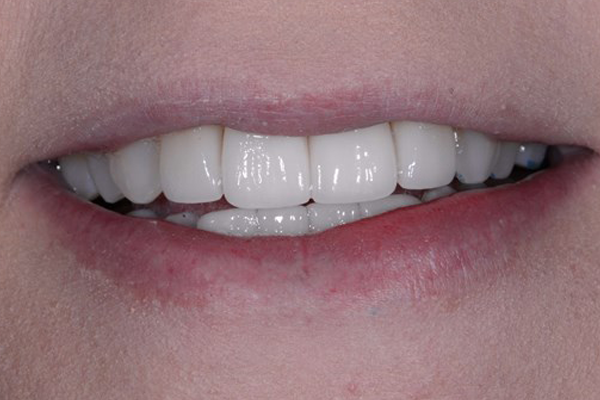 Porcelain Veneers After Case C Dr. Ferrari