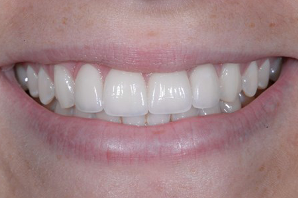 Porcelain Veneers After Case D Dr. Ferrari
