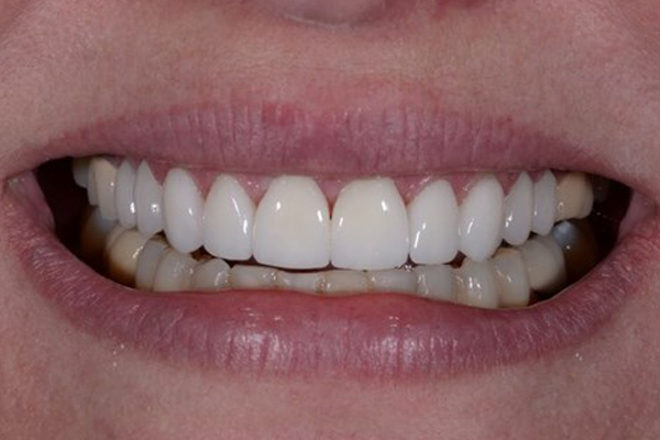 Porcelain Veneers After Case A Dr. Ferrari