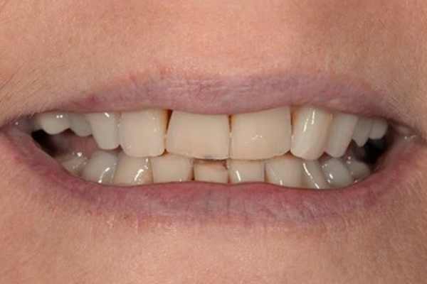 Porcelain Veneer Before Case B Dr Ferrari