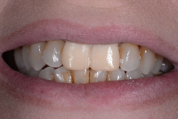 Porcelain Veneers Before Case C Dr Ferarri