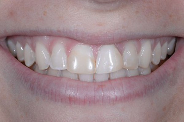 Porcelain Veneers Before Case D Dr. Ferrari