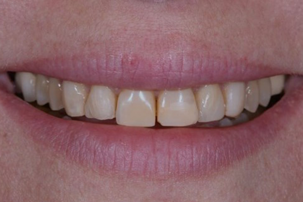 Porcelain Veneer Before Case A Dr. Ferrari<span id=