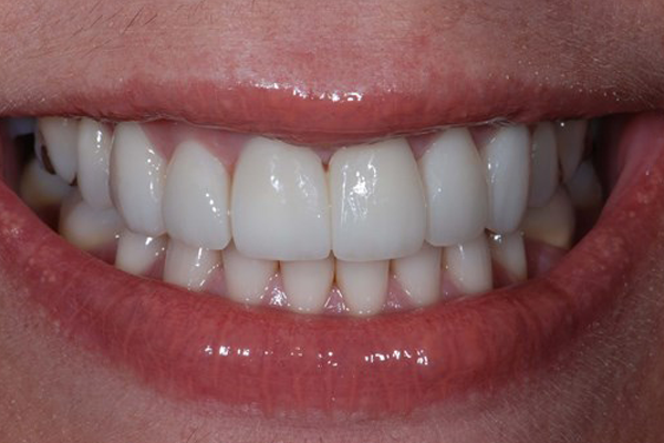 After Case A - Porcelain Veneer - Dr. Daniel ALdieri