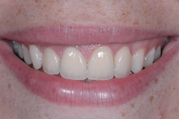 After Case B - Porcelain Veneers - Dr. Daniel Aldieri