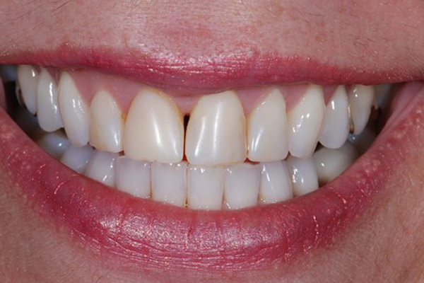 Before Case A - Porcelain Veneers - Dr. Daniel Aldieri