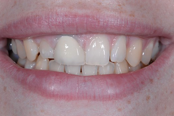 Before Case B - Porcelain Veneers Dr. Daniel Aldieri